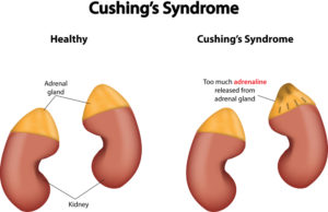 Cushings Disease