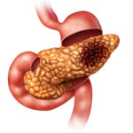 Pancreatitis